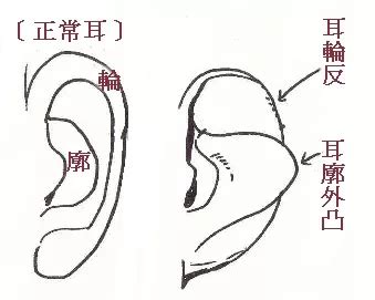 反廓耳|耳朵廓反：个性反叛，爱争辩